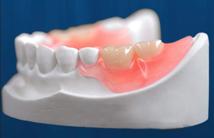 Jaw Registration For Partial Dentures Orange CA 92865